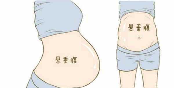孕期悬垂腹是怎么形成的？悬垂腹肚子照片图片